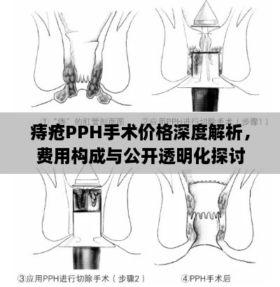 痔瘡PPH手術價格深度解析，費用構成與公開透明化探討