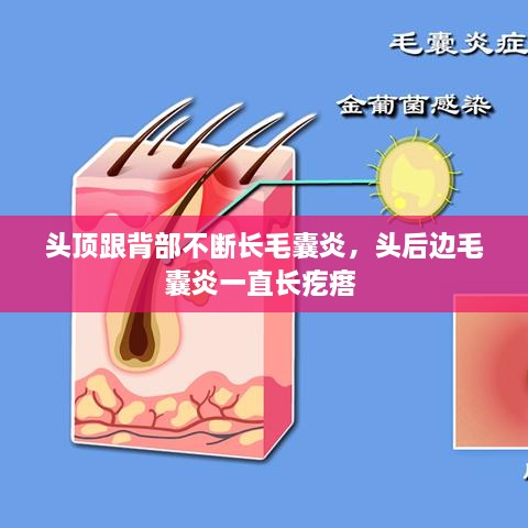 頭頂跟背部不斷長毛囊炎，頭后邊毛囊炎一直長疙瘩 